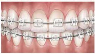 Ceramic braces provider