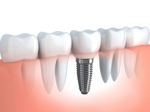 Dental Implant in Geneva IL
