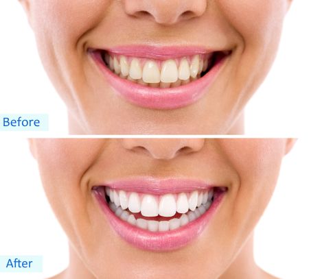 Batavia dentist offers teeth whitening